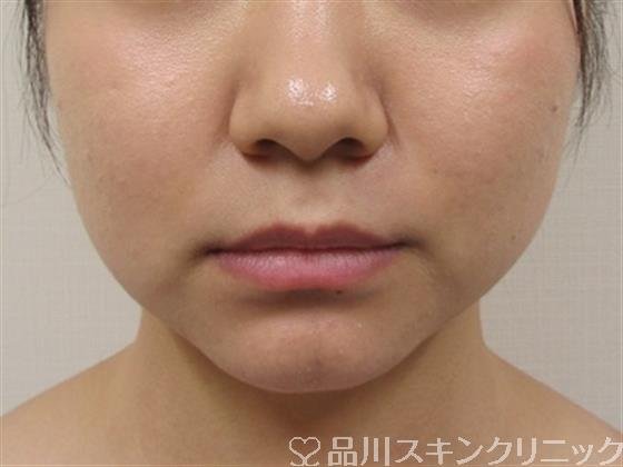 症例NO.35395のBEFORE写真