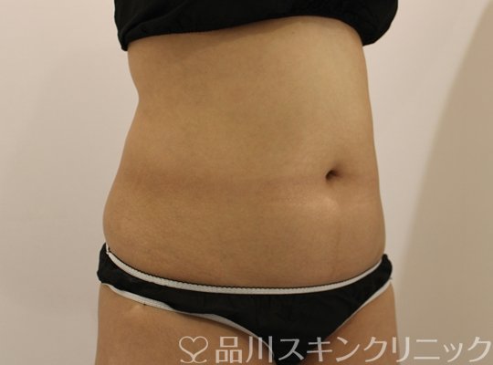 症例NO.73653のAFTER写真