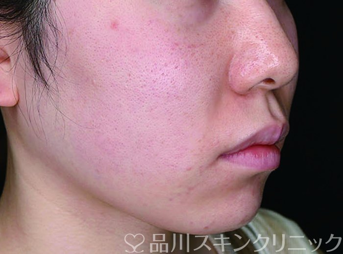 症例NO.70477のBEFORE写真