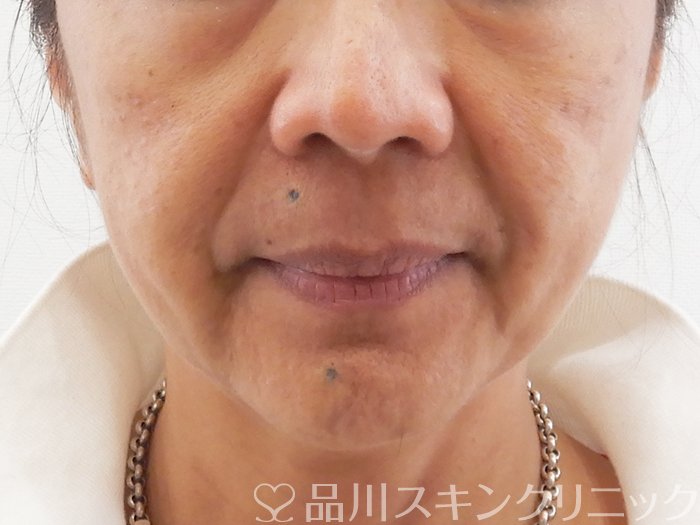 症例NO.63732のBEFORE写真