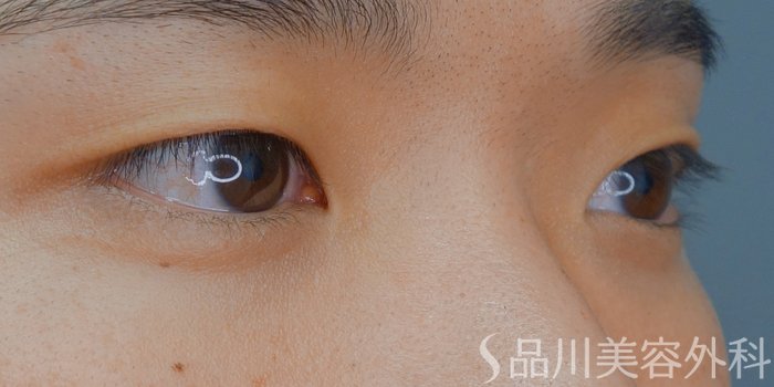 症例NO.70414のBEFORE写真