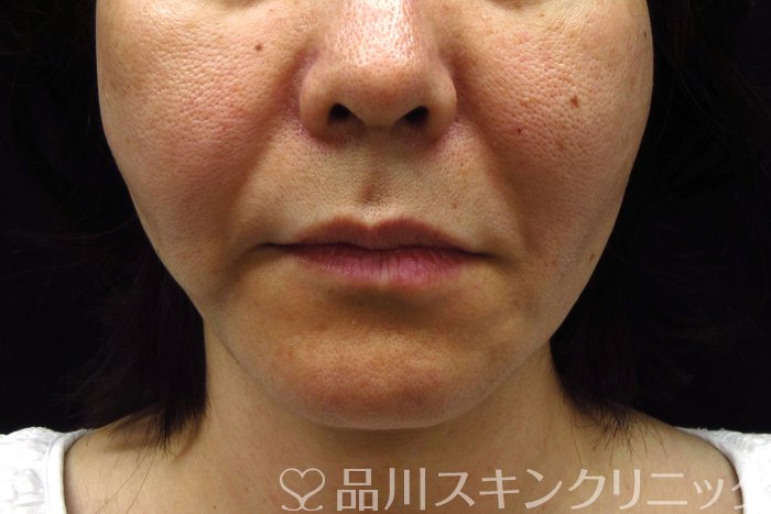 症例NO.74320のAFTER写真