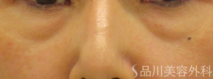 症例NO.62093のBEFORE写真