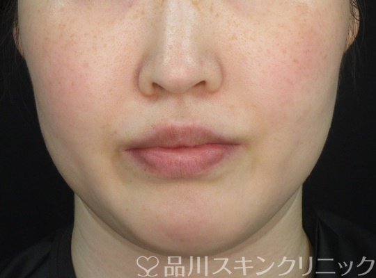 症例NO.71060のAFTER写真