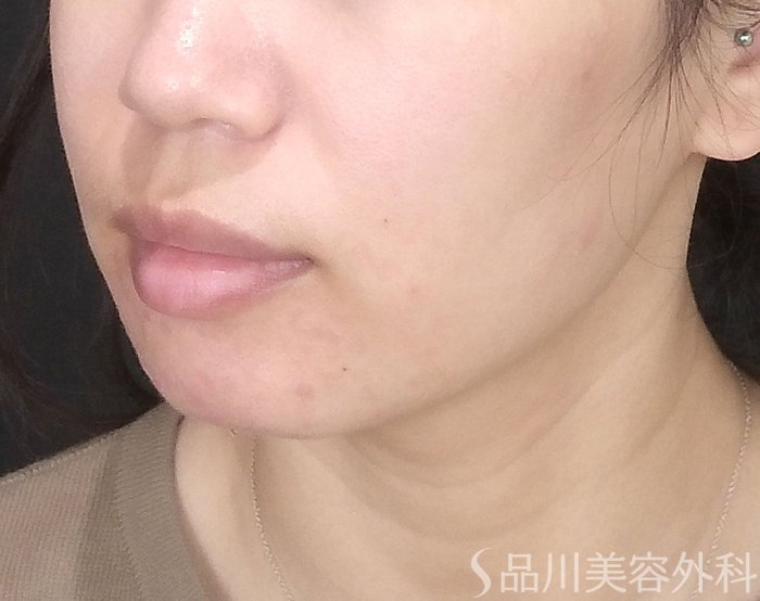 症例NO.67981のBEFORE写真