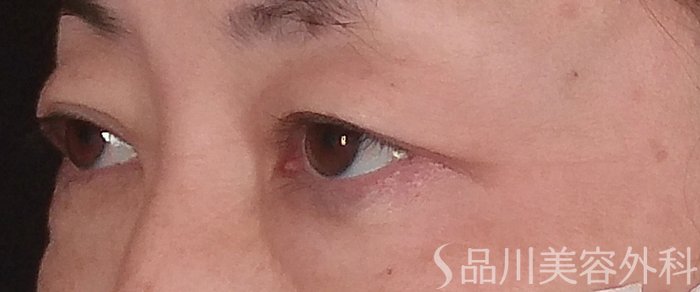 症例NO.70856のBEFORE写真