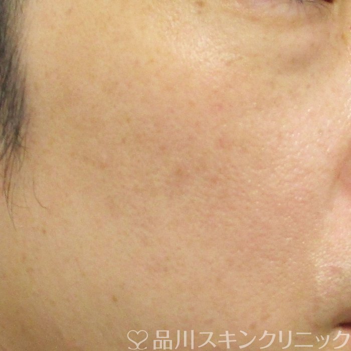 症例NO.74225のAFTER写真