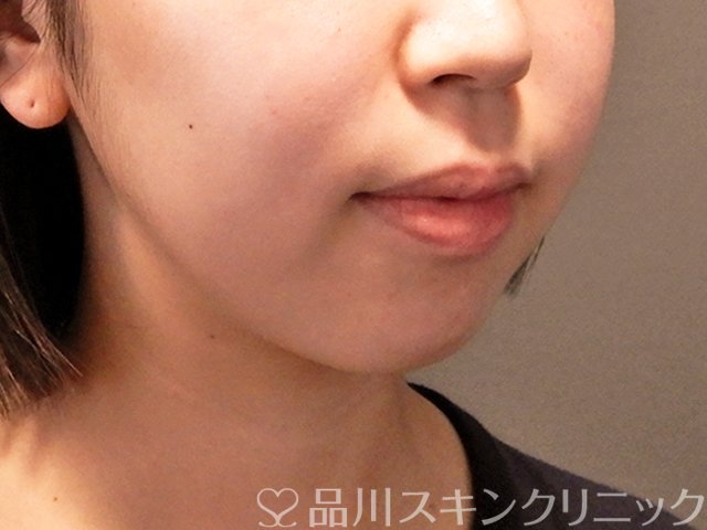症例NO.70992のBEFORE写真