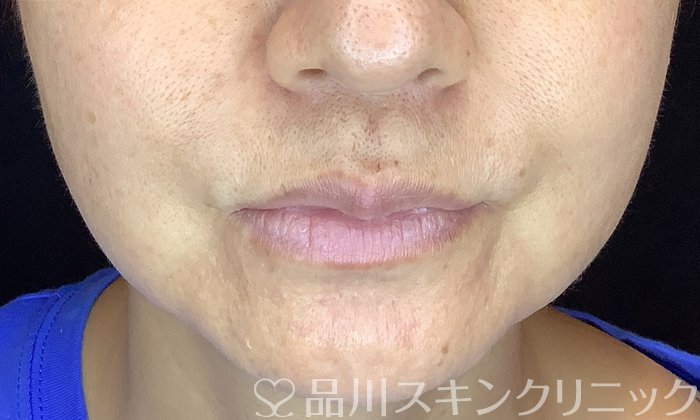 症例NO.71842のBEFORE写真
