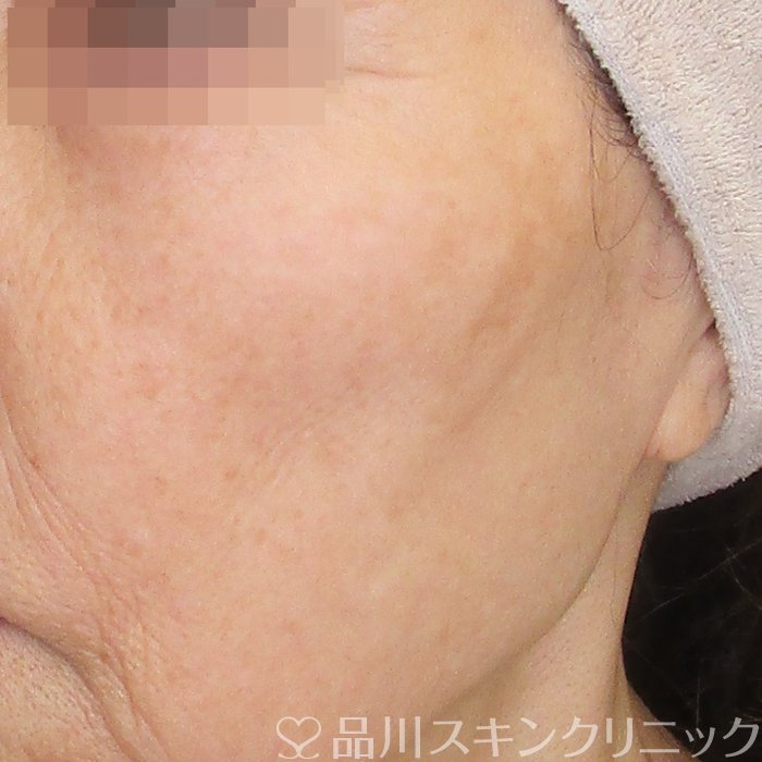 症例NO.75159のAFTER写真