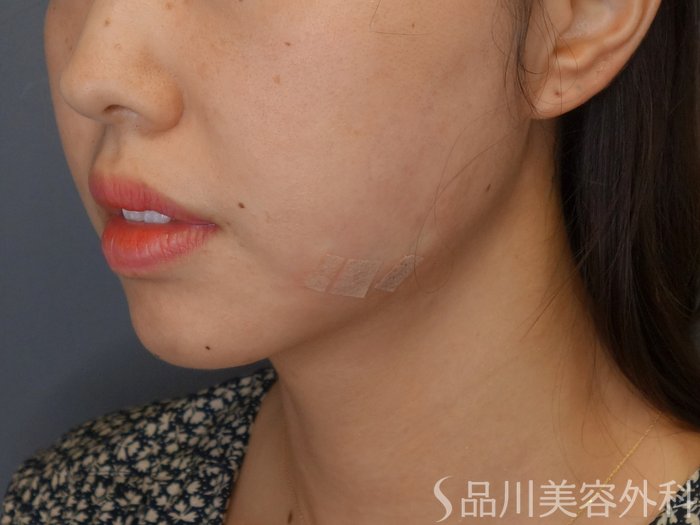 症例NO.71915のAFTER写真