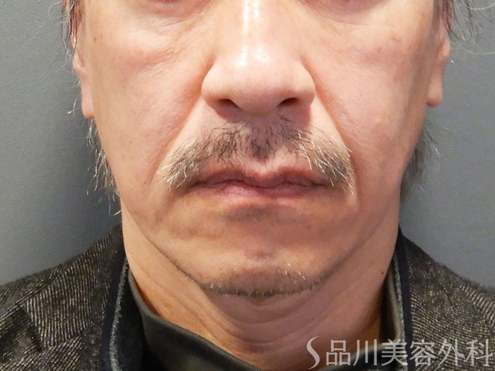 症例NO.70468のBEFORE写真