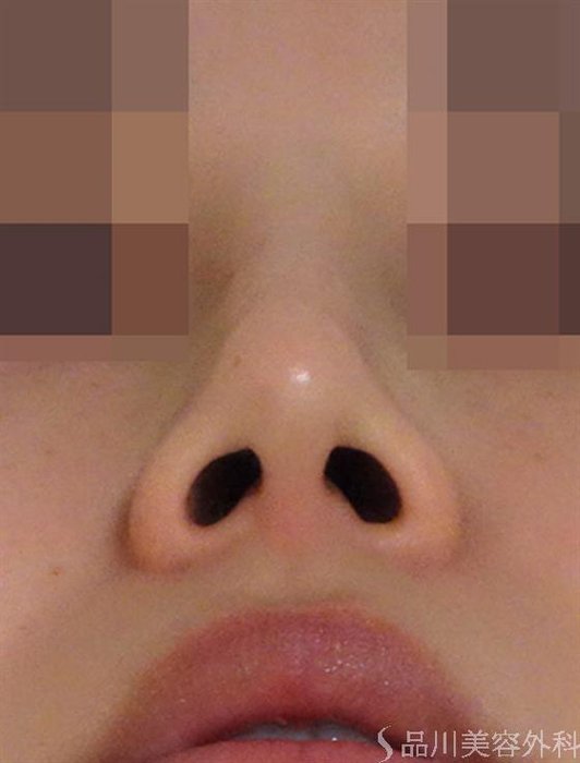 症例NO.44042のAFTER写真
