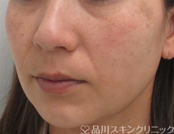 症例NO.27302のBEFORE写真