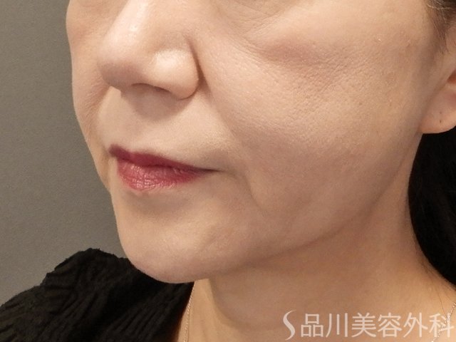 症例NO.72211のAFTER写真