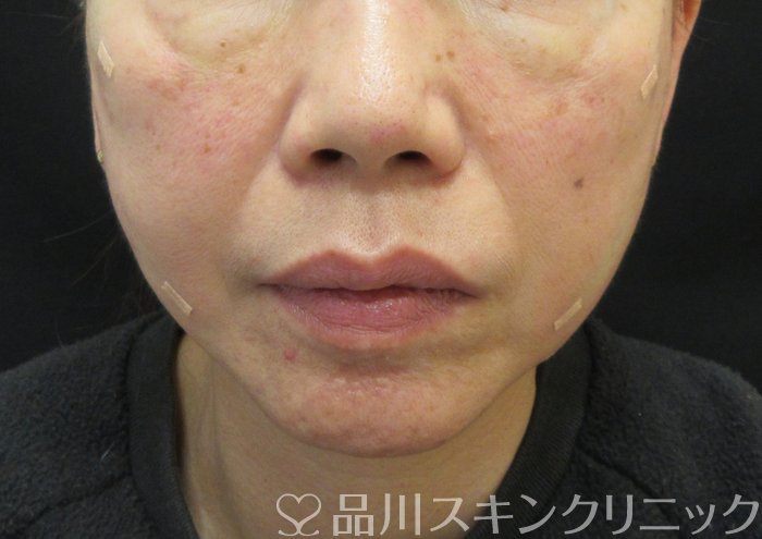 症例NO.74186のAFTER写真