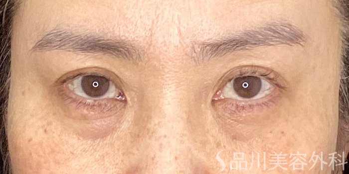 症例NO.71216のBEFORE写真