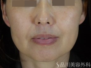 症例NO.74701のBEFORE写真