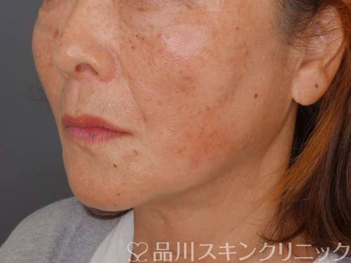 症例NO.73018のAFTER写真