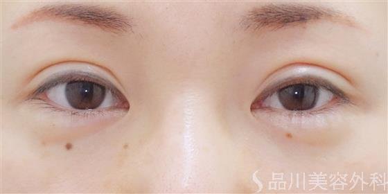 症例NO.39995のAFTER写真