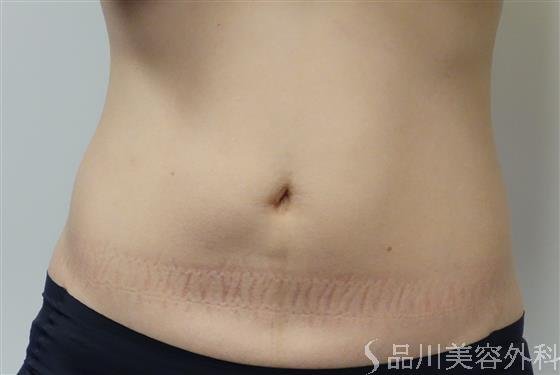 症例NO.51448のBEFORE写真