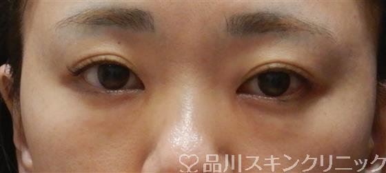 症例NO.60997のBEFORE写真