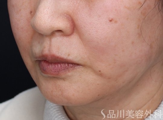 症例NO.73764のAFTER写真