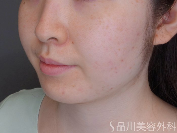 症例NO.74067のBEFORE写真