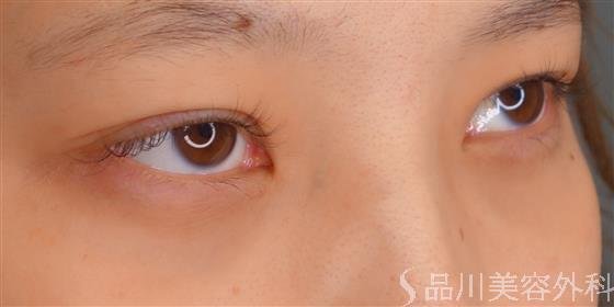 症例NO.53191のAFTER写真