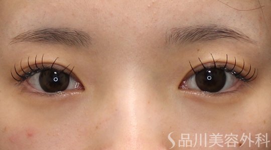 症例NO.74902のAFTER写真