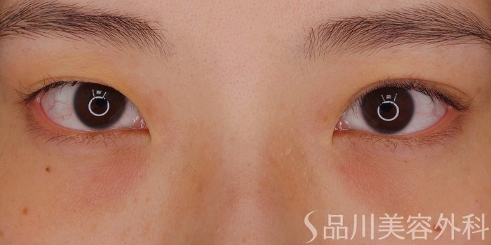 症例NO.72352のBEFORE写真