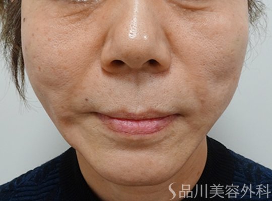 症例NO.71758のAFTER写真