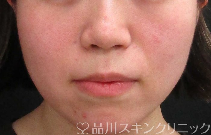 症例NO.68401のBEFORE写真