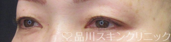 症例NO.70067のBEFORE写真
