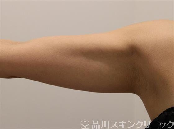 症例NO.47483のBEFORE写真