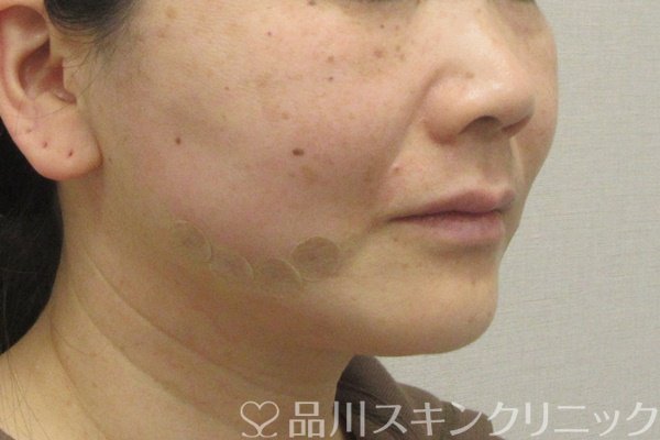 症例NO.74163のAFTER写真