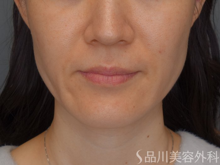 症例NO.72283のBEFORE写真