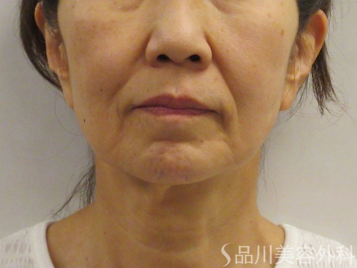 症例NO.75081のBEFORE写真
