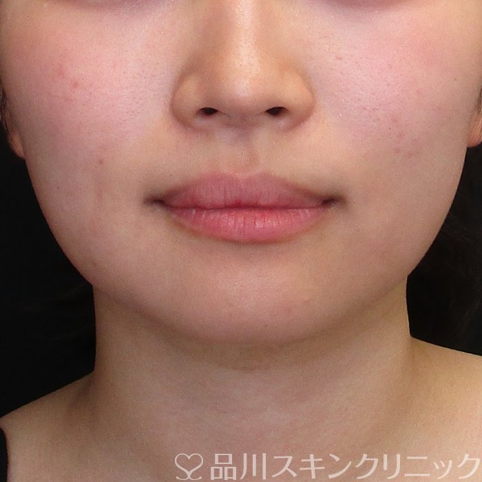 症例NO.73130のBEFORE写真