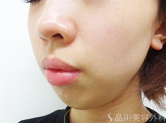 症例NO.21955のBEFORE写真