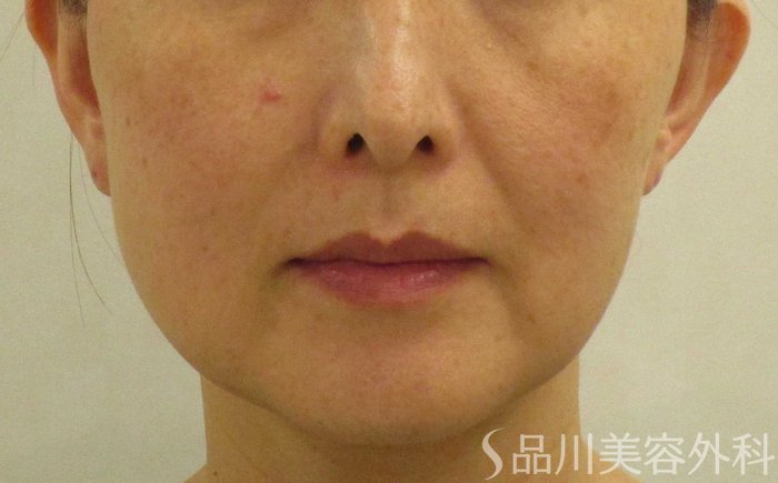 症例NO.64886のBEFORE写真