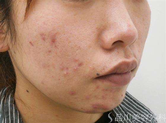 症例NO.31582のBEFORE写真