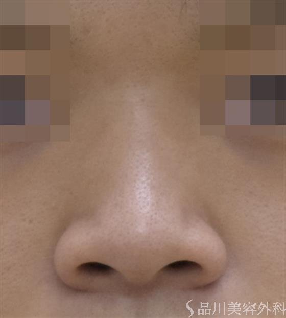 症例NO.48137のBEFORE写真