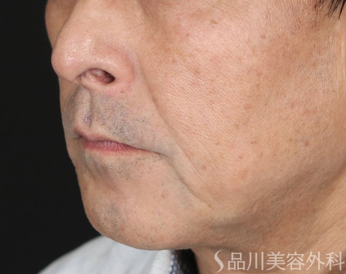 症例NO.71607のBEFORE写真