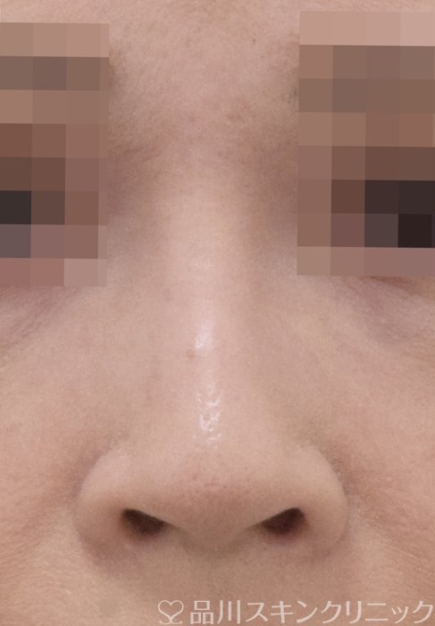 症例NO.71680のAFTER写真