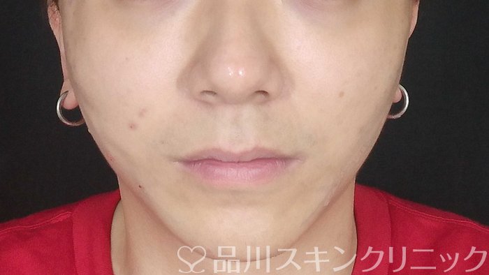症例NO.71366のAFTER写真