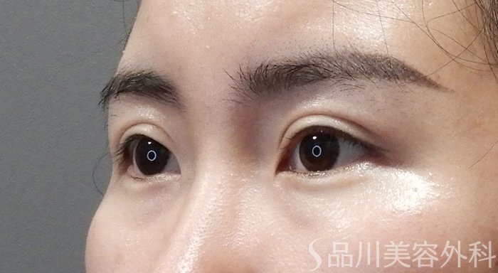 症例NO.70823のAFTER写真