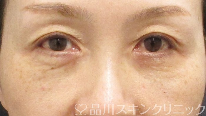 症例NO.69892のAFTER写真