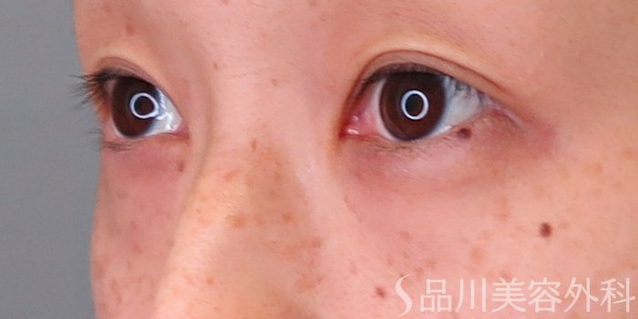 症例NO.71289のBEFORE写真
