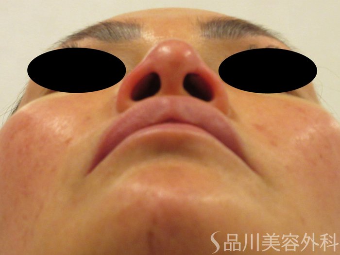 症例NO.75205のAFTER写真